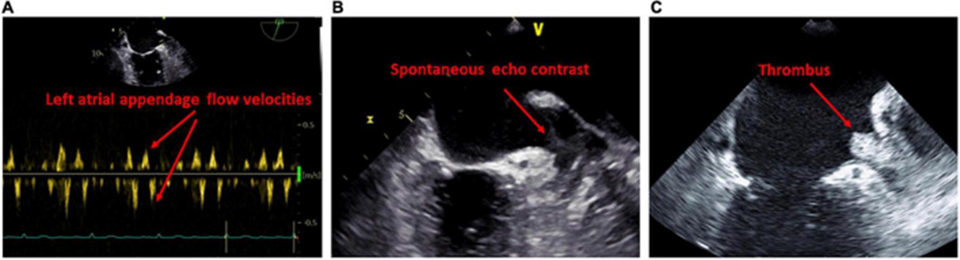 【佳学基因检测】飞行质谱基因评估分析发现CRYBA2有突变，严重吗？